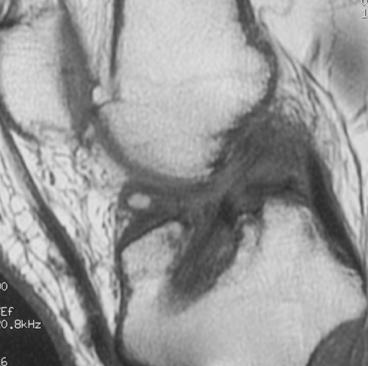 Revision ACL Graft Rupture